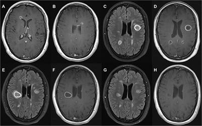 Case report: tumefactive demyelinating lesions after the second cycle of alemtuzumab in multiple sclerosis; immune cell profile and biomarkers